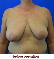 plastic-surgery-breast-lift-augmentation